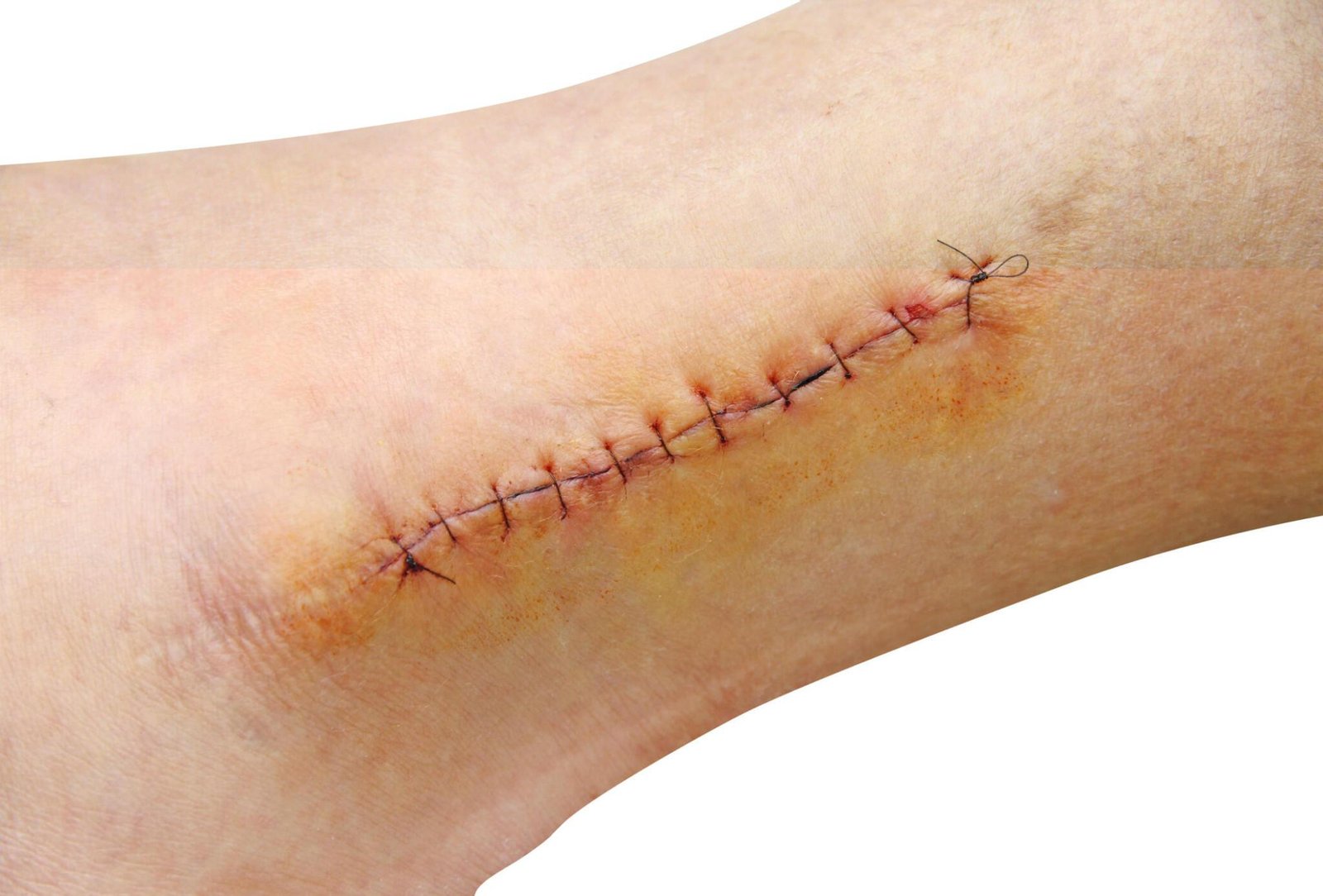 Wound Assessment & Suture Removal